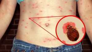 Ako bedbill ugrize dijete?